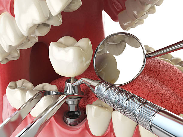 Best Chipped Tooth Repair Near Me  in Ferriday, LA